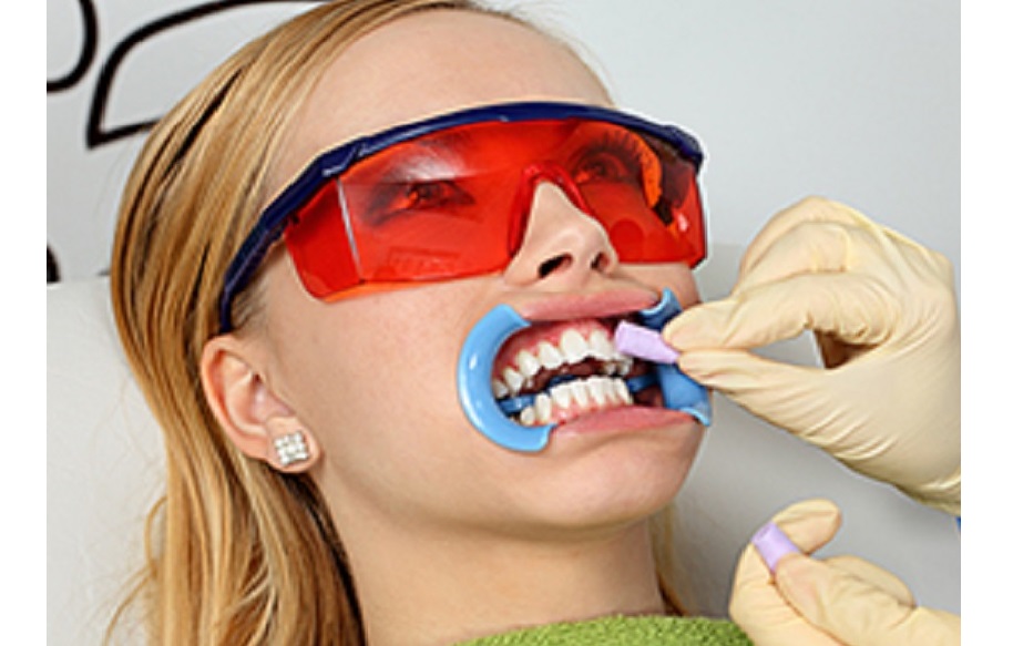 Sbiancamento-con-laser-extended