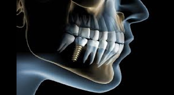 implantologia3